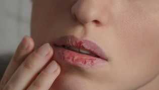 Dokter: Jangan Jilati Bibir Kering Saat Puasa