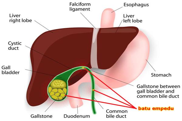Gejala-gejala Anda Mungkin Mengidap Batu Empedu, Cek Sekarang